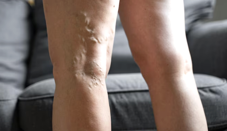 Křečové žíly trápí ženy i muže. Prevencí je žilní gymnastika
