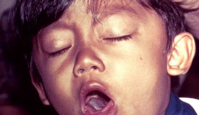 Hygienici evidují vyšší počet případů černého kašle