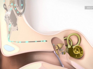 Lékaři FNUSA zavedou aktivní středoušní implantát. Jako první v ČR