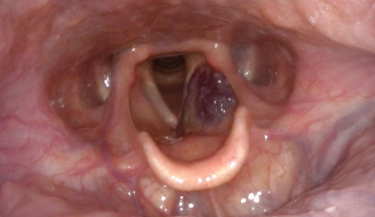 Cévní tumor hrtanu, Foto FNUSA-KOCHHK