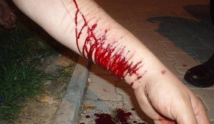 Pořezané ruce, ilustrační foto, zdroj: Městská policie Plzeň