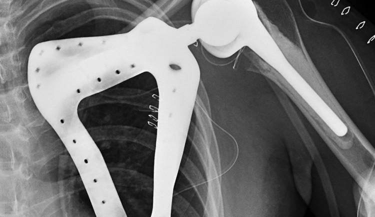 Brněnští lékaři provedli jako první v republice unikátní implantaci ramene i s lopatkou