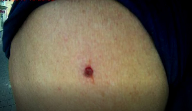 Rána po zásahu diabolkou do zad