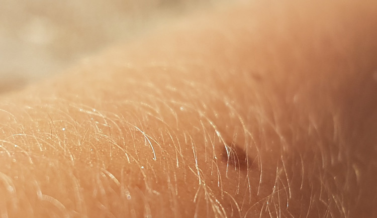 Vědci z Brna vyvíjí revoluční techniku k odhalení rakoviny kůže, nemoc ročně zabije 450 lidí v Česku