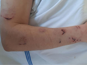 Brutální napadení na Vyškovsku. Agresor zmlátil muže a poštval proti němu psa