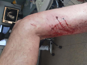 Brutální napadení na Vyškovsku. Agresor zmlátil muže a poštval proti němu psa