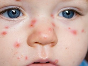 Na jižní Moravě řádí neštovice. Nakažených dětí je osmkrát víc než loni