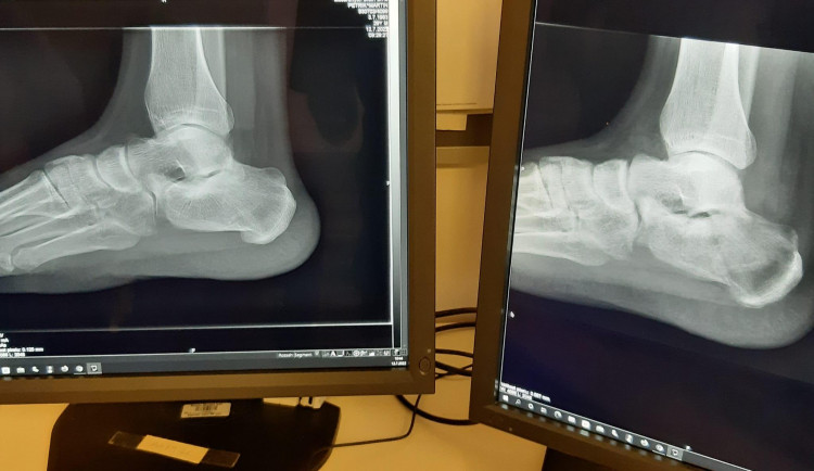 Rentgen_ rozdil vykresleni snimku