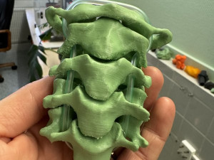 Lékaři v Brně používají 3D modely kostí a orgánů, aby lépe operovali
