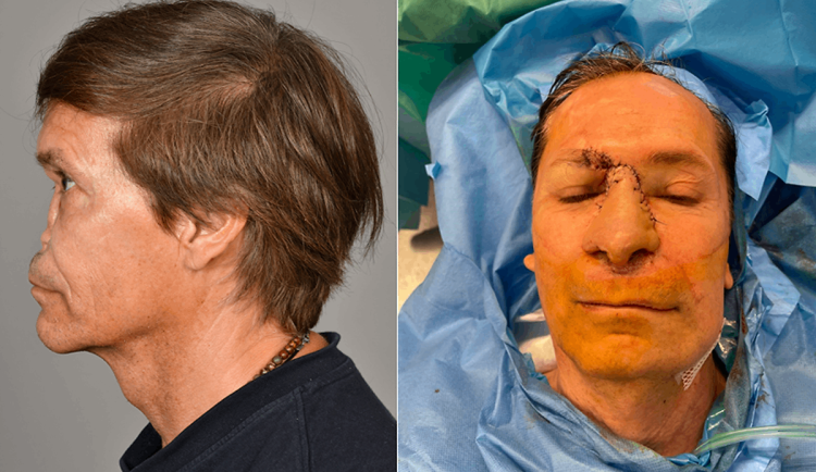 Muž kvůli nádoru přišel o nos. Chirurgové z Brna mu vytvořili nový, pomohly 3D technologie