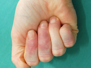 Jak ošetřit amputovaný prst? Zastavit krvácení, zabalit do gázy a volat sanitku