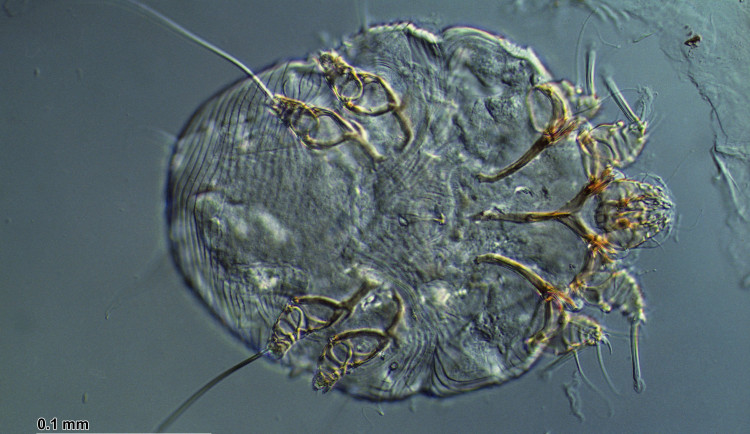 Na základní škole zjistili svrab. Plzeňský kraj patří mezi nejvíce postižené v republice