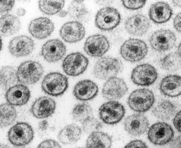 Virus HIV pod elektronovým mikroskopem