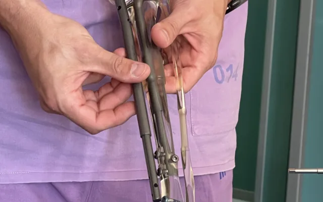 Malá Lucinka se narodila s jednou nohou kratší. Po operaci v Brně si ji sama prodlužovala