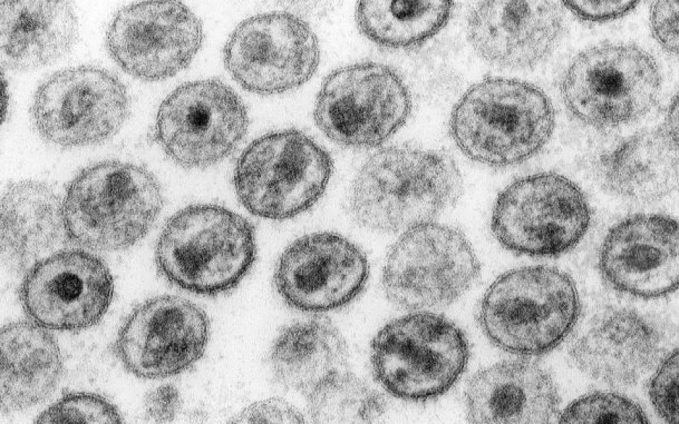 Virus HIV pod elektronovým mikroskopem