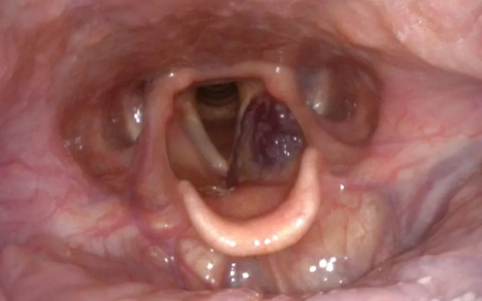 Cévní tumor hrtanu, Foto FNUSA-KOCHHK